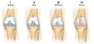 progresión de la rodilla